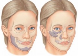 Оновные особенности и процесс проведения имплантации скул