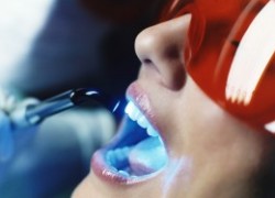 Ультрасовременная техника отбеливания зубов