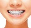 Брекеты — ключ к здоровью и красоте