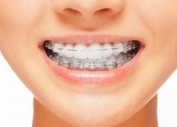 Брекеты — ключ к здоровью и красоте